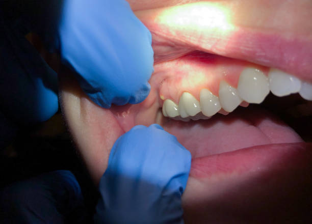 Best Emergency Broken Tooth Repair in Amherst, OH
